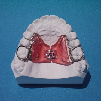 palatal expander